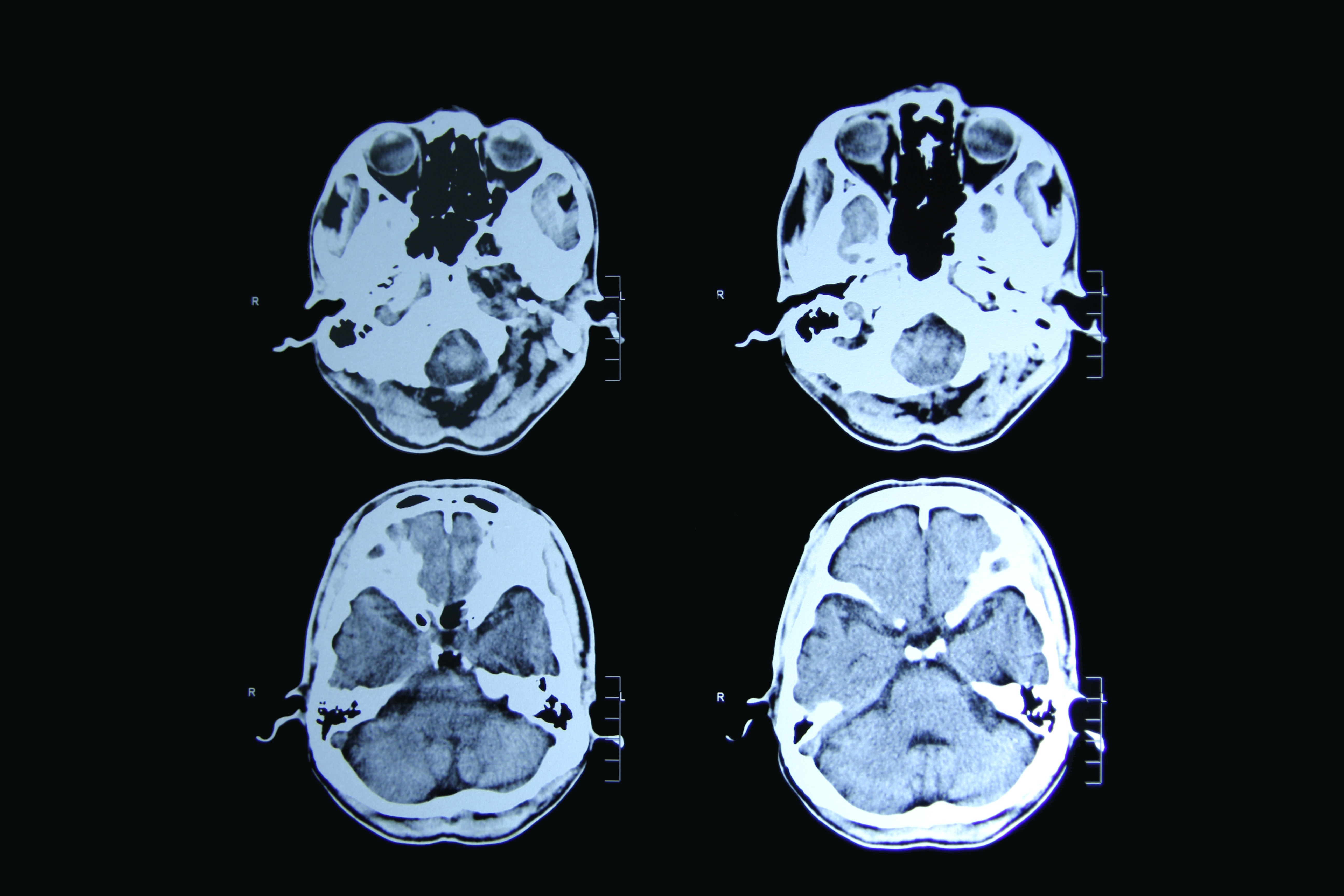 shutterstock_Huntingdon-Disease.jpg